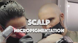 Ink 2 Scalp Micropigmentation - #1 SMP Studio in Ontario