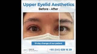 Upper Eyelied (Blepharoplasty) Surgery - Before & After | mezMD Health Tourism Agency