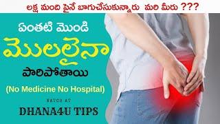 External Piles | బాహ్య మొలలు ఇంట్లోనే బాగుచేసుకోండి | No Hospital - No Medicine