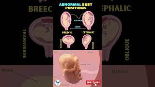 ️️Understanding Abnormal Baby Positions | Pregnancy positions | Baby position in womb #shortsfeed
