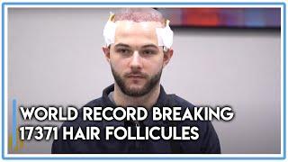 World Record Breaking Hair Transplant: 17371 Hair Follicules with Results [BEFORE-AFTER]