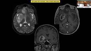  Management of Lenticulostriate Arteries Engulfed within the Insular GBM