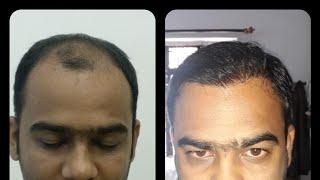 Hair Transplant Surgery Review, Dr. Umang Kothari, The Hair And Shape Clinic, Malad, Mumbai.