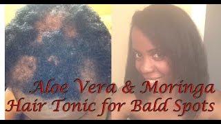 Aloe Vera with Moringa Hair Tonic Tutorial for Bald Spots