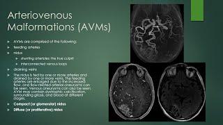 Brain vascular malformations