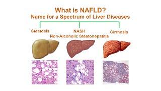 بیماری کبد چرب غیر الکلی (NAFLD) چیست؟