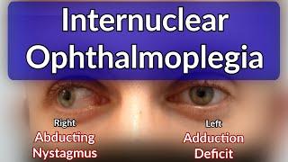 Internuclear Ophthalmoplegia - Left INO Case example explained