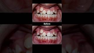 20 months Braces Transformation #braces #dentist #orthodontist #dental