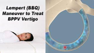 Lempert (BBQ) Maneuver to Treat BPPV Vertigo