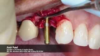 One-stage surgery using Tapered Internal PLUS dental implant from BioHorizons