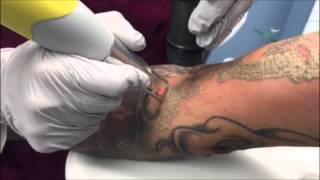 Laser Tattoo Removal (Full Sleeve) Skin Deep Laser Services,Burke VA, Fairfax County VA, Northern VA