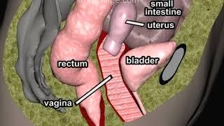 Pelvic Organ Prolapse Animation by Cal Shipley, M.D.