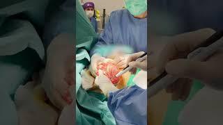 Plastic surgeon G. Samulenas removing breast implants for a patient with capsular contracture.