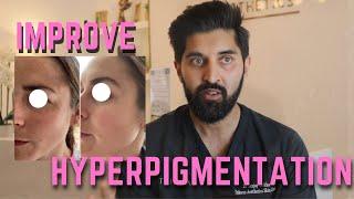 No more HYPERPIGMENTATION with skin boosters | decrease dark circles