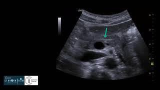 Sonographie des Pankreas