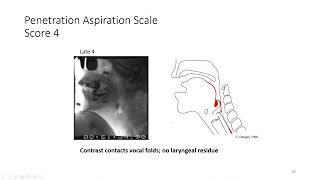 #e298 Preview: The Penetration-Aspiration Scale