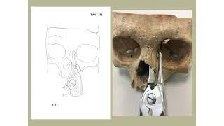 GUASTELLA NEW METHOD FOR LATERAL OSTEOTOMIES IN RHINOPLASTY