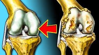 آرتروز یا سایــیدگی مفصل چیست و چه علائمی دارد و مواد غذایی برای درمان