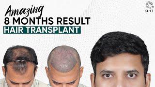 Hair Transplant in Istanbul | Best Results & Cost of Hair Transplant in Istanbul