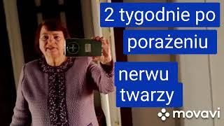 @Mariazaprasza 2 tygodnie po porażeniu nerwu twarzy.Jak wyglądam? Rehabilitacja. Zapraszam️