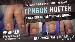 Грибок ногтей. Убираем в домашних условиях. Пальчики, как у младенца. @Podolog__eva