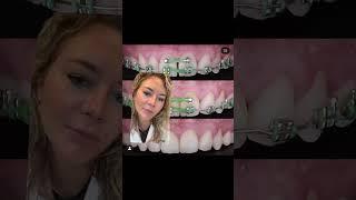 Closing a diastema #teeth #ortho #orthodontist #braces