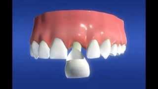 Dental Crowns