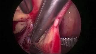 Dr. Arun Singh Aortic RA Fistula Final v1