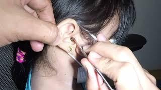 Removing GIANT Earwax from Girl's Ear