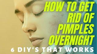 How To Get Rid Of Pimples OVERNIGHT: 6 DIY’s That Work! 2021