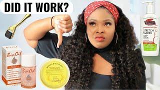 I Tried TOP 5 STRETCH MARKS REMOVAL PRODUCTS | Best Products To Remove Stretch Marks