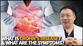 Crohn's Disease | CloudHospital TV