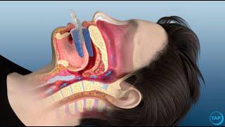 flexTAP Oral Appliance for Sleep Apnea: How Does It Work?