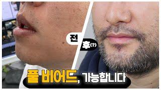 풀 비어드 수염을 갈망하는 분들을 위한 수염 이식의 모든 것