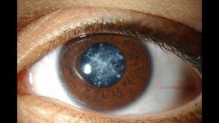 Explanation on Cataract - Lens Replacement - Glaucoma - Nyctalopia | Zoology (Tamil)