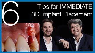  [Immediate Dental Implant Placement] 6 Tips for Success - Implantology Talks