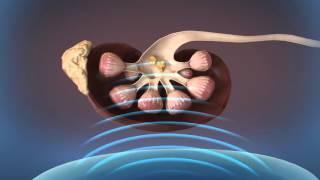 Shockwave Lithotripsy (SWL)