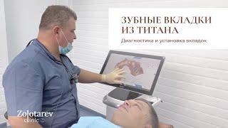 Восстановление зубов титановыми вкладками