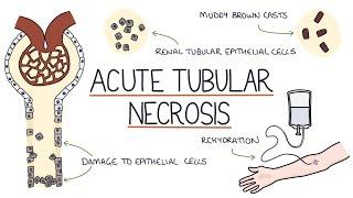 Understanding Acute Tubular Necrosis