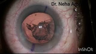 High Myopia Cataract Surgery#Phaco Surgery#Soft Cataract