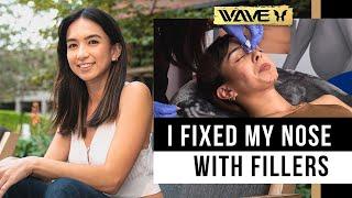 Using Radiesse as a Nose Filler - Anika's Nose Filler Experience  | Wave Plastic Surgery