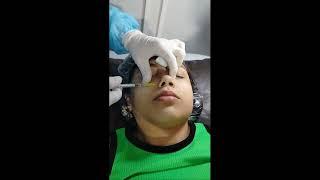 Aplicação avançada do dysport em toda face/Advanced application of dysport on the entire (full) face