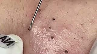 blackheads acne treatment blackheads new 2023 today blackheads new this week