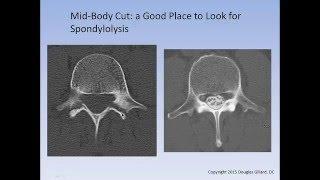 The Spondylolysis / Spondylolisthesis Lecture