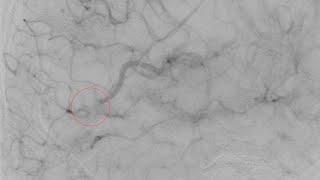 M4 mechanical thrombectomy on an aphasic patient...