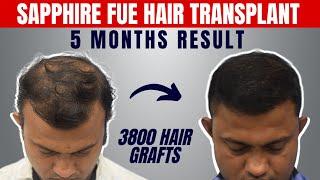 3800 Grafts Sapphire Fue Hair Transplant Results and Case Study.