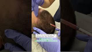 {2024) PRP Treatment | Post Hair Transplant Technique #shorts #shortsfeed Medlinks