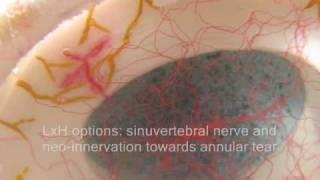 LxH by Dynamic Disc Designs Corp. Realistic Spinal Disc Models