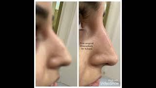 Non surgical nose job/ nose reshaping by doctor Saleem