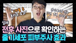 17년차 청담의사도 놀란 모즈셀 줄기세포 피부주사의 놀라운 결과. ㅣ ㅣ모즈의원- 모즈클리닉